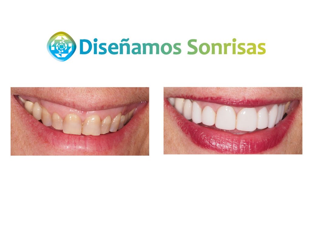Composite: Preguntas frecuentes | Estética Dental en Madrid